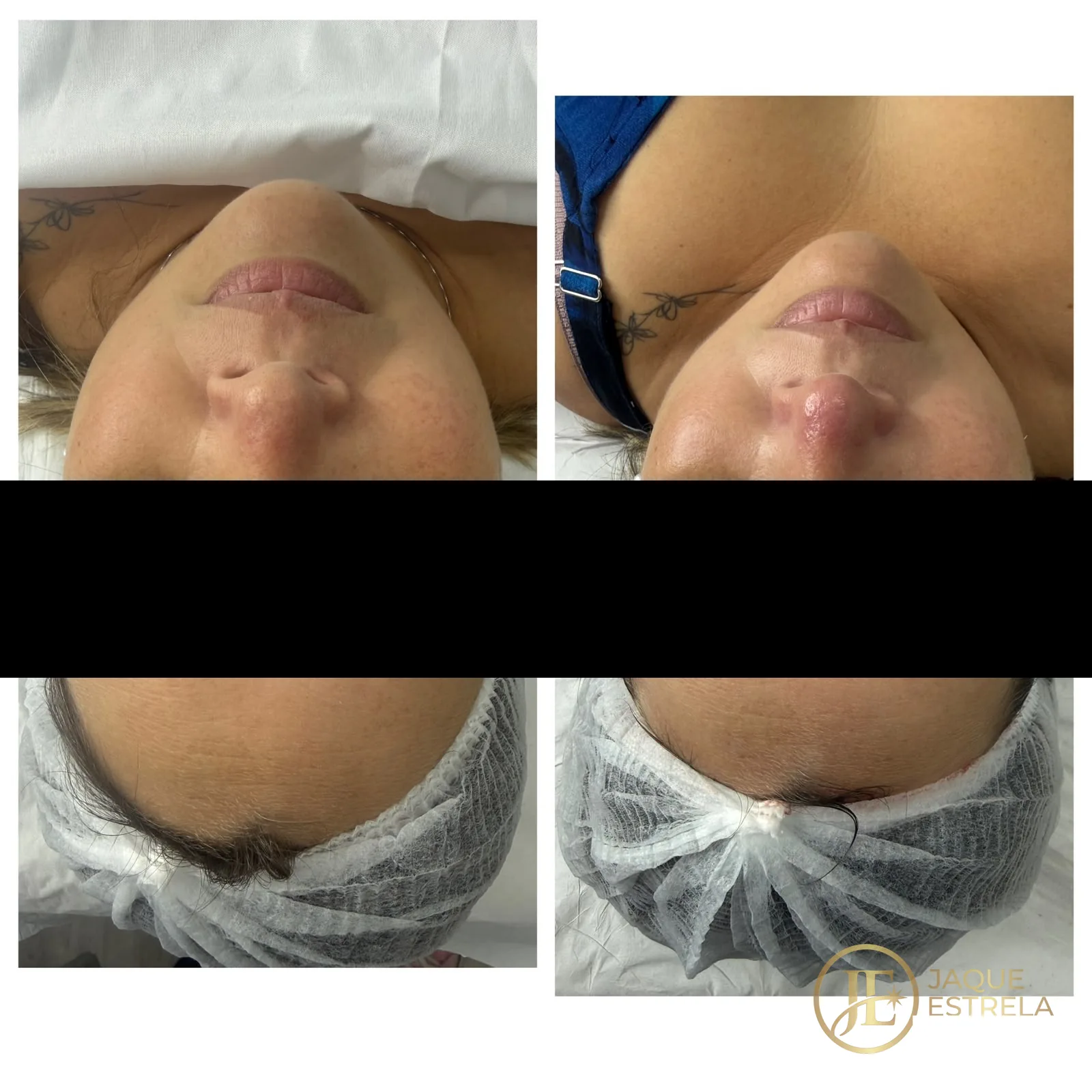 Antes e depois de limpeza de pele — resultado real de cliente da Jaque Estrela