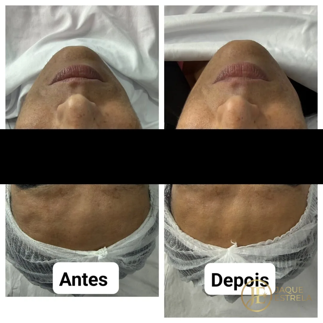 Antes e depois de cuidado facial — resultado real