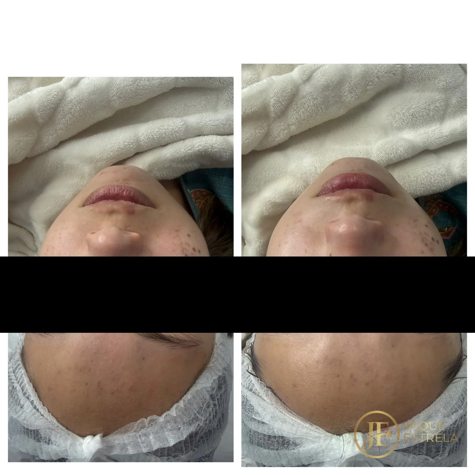Antes e depois de limpeza de pele — resultado real