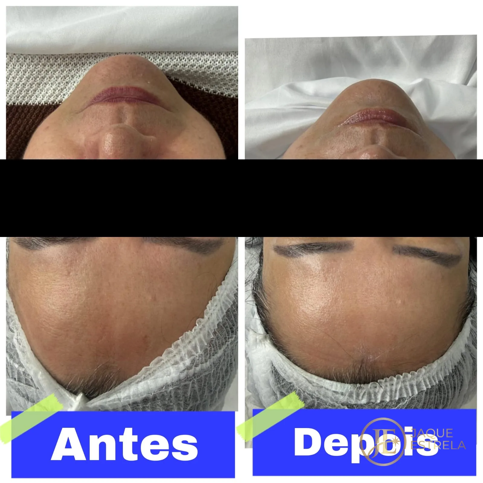 Antes e depois de cuidado facial — resultado real