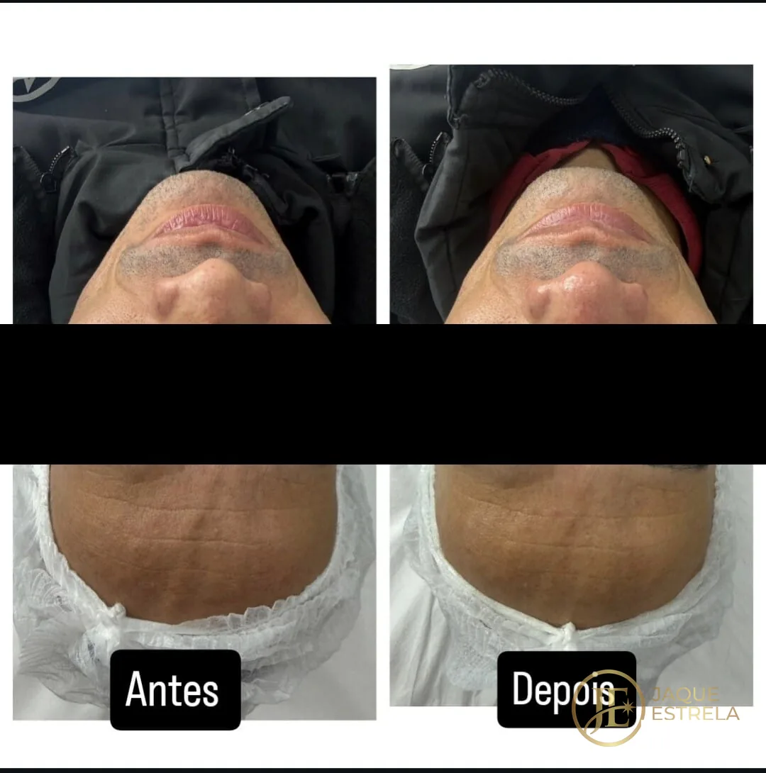 Antes e depois de cuidado facial masculino — resultado real