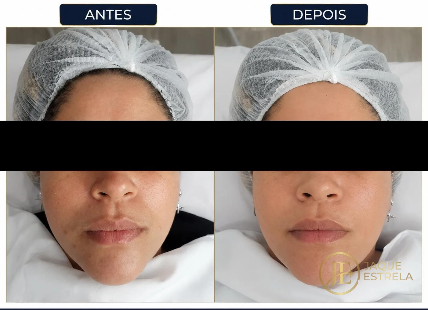 Antes e depois de limpeza de pele — resultado real