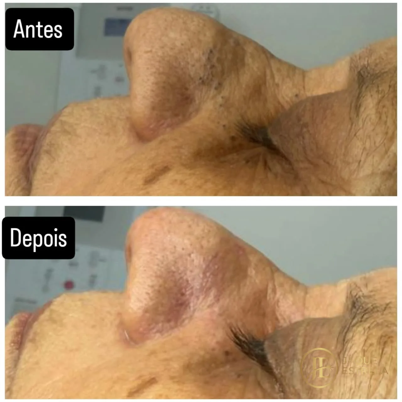 Antes e depois reais de limpeza profunda no nariz — close sem identificação da cliente