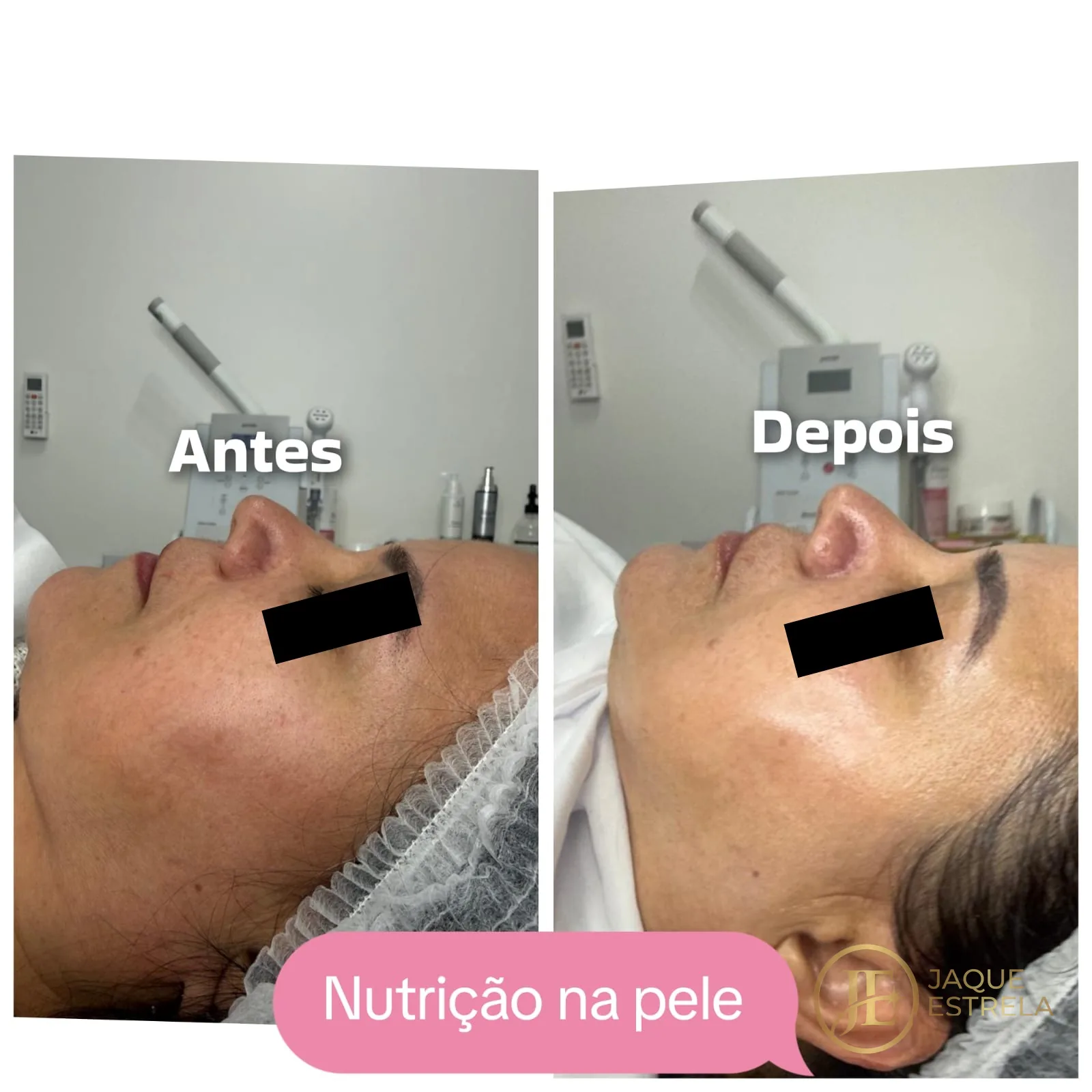 Antes e depois reais de nutrição na pele — mesma cliente, identidade preservada