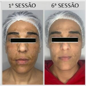 Clareamento Sem Medo: pele na 1ª e na 6ª sessão (cliente real, identidade preservada)