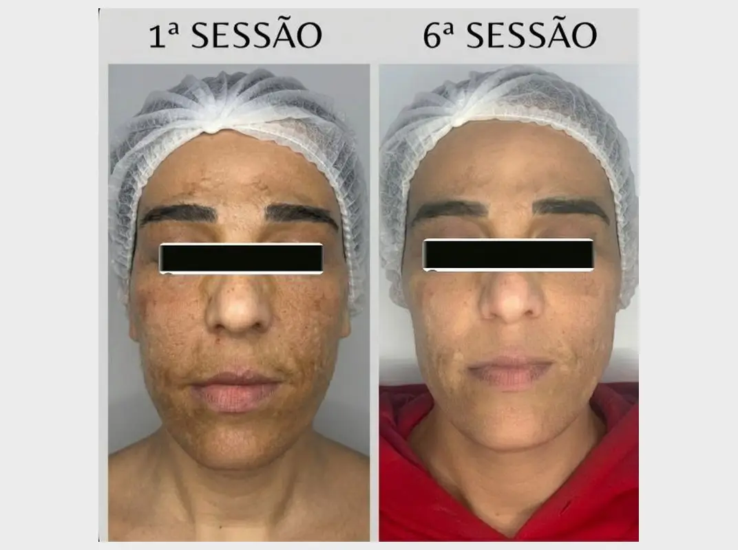 Clareamento Sem Medo: pele na 1ª e na 6ª sessão (cliente real, identidade preservada)
