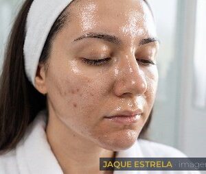 Pele oleosa com acne, indicação do Peeling (imagem ilustrativa)