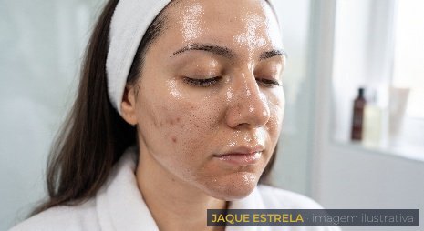Pele oleosa com acne, indicação do Peeling (imagem ilustrativa)