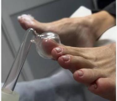 Alta frequência aplicada nos pés