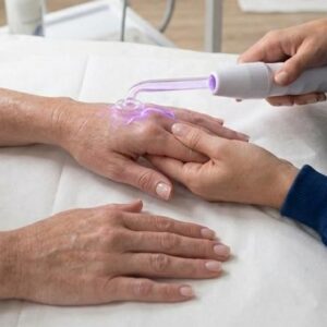 Alta Frequência Pós-Manicure
