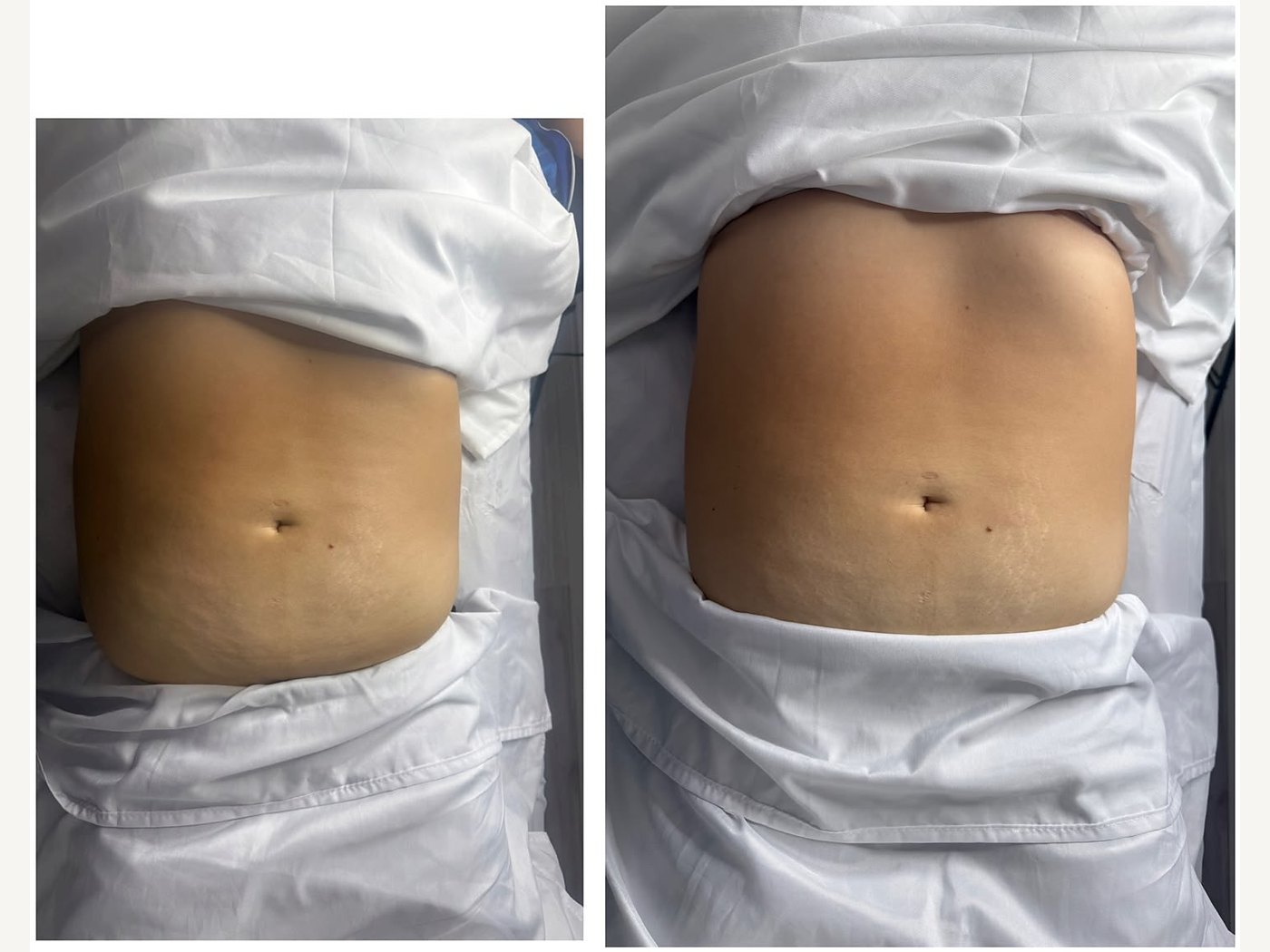 Antes e depois de drenagem linfática no abdômen — atendimento real