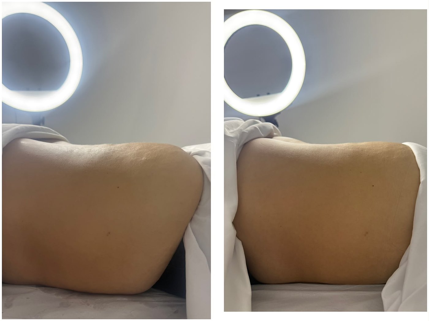 Antes e depois de drenagem modeladora — atendimento real