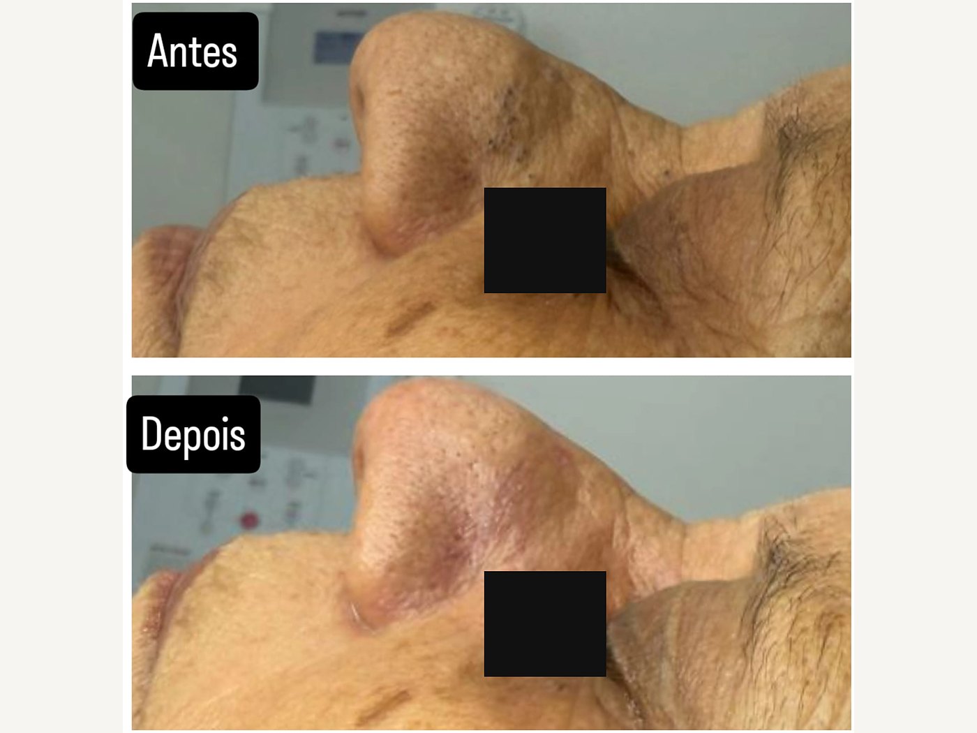 Antes e depois de extração de cravos — atendimento real, com tarja