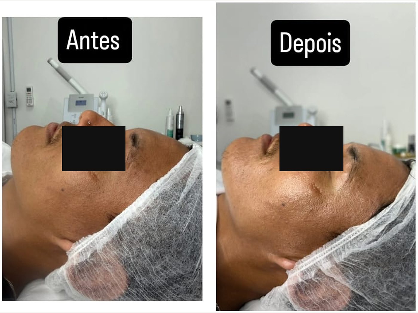 Antes e depois de limpeza de pele — atendimento real, com tarja