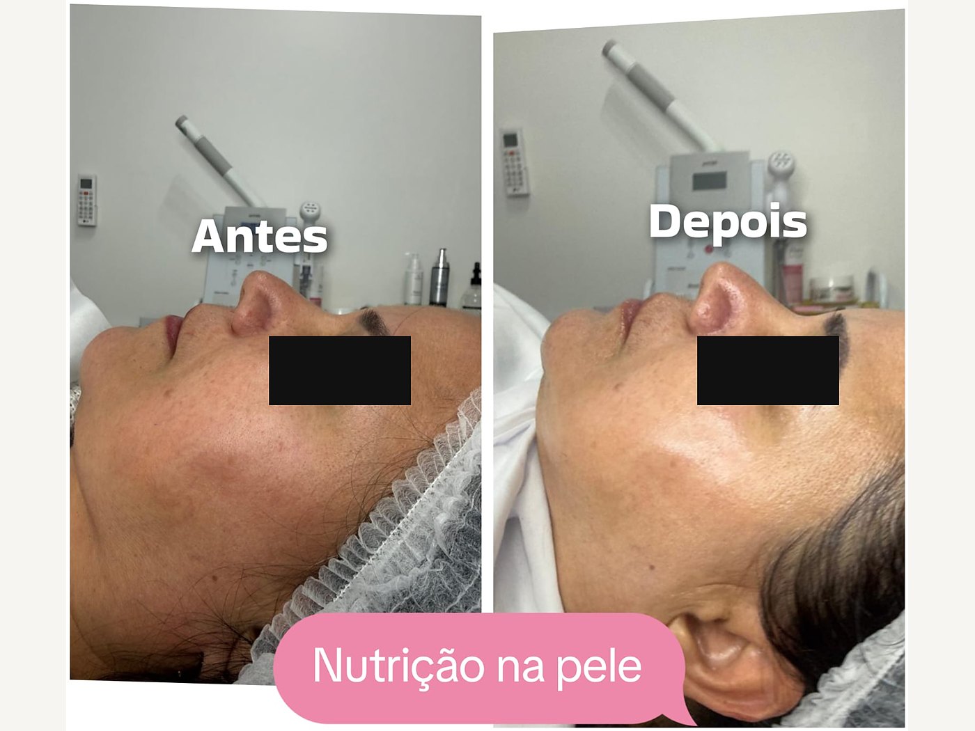 Antes e depois de nutrição facial — atendimento real, com tarja