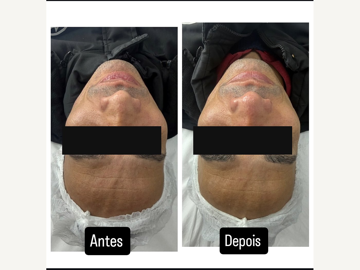 Antes e depois de limpeza de pele masculina — atendimento real, com tarja