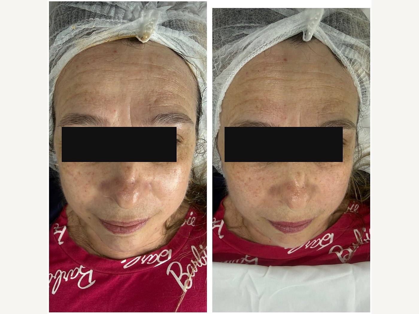 Antes e depois de revitalização facial — atendimento real, com tarja